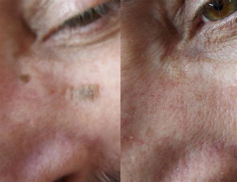 removal of seborrheic keratosis at home 6