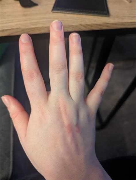Swollen and aching fingers and wrist : r/DiagnoseMe