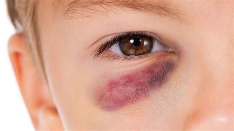 how to take care of a black eye