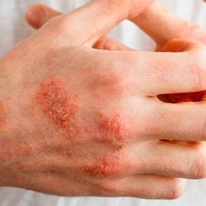 Канизон Плюс: инструкция по применению, состав, противопоказания ...