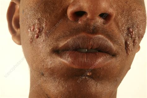 Acne vulgaris - Stock Image - C053/0038 - Science Photo Library