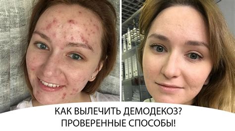 КАК ВЫЛЕЧИТЬ ДЕМОДЕКОЗ