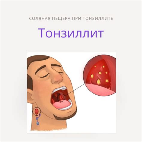 Галотерапия и тонзиллит
