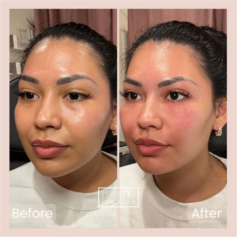 PRF EZ Gel Scottsdale: Under Eye, Face, Hand Rejuvenation