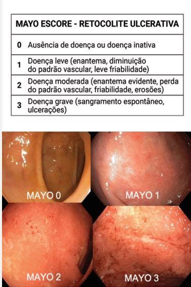 Retocolite Ulcerativa Incha A Barriga - UMA VISÃO GERAL DE RETOCOLITE ULCERATIVA: DO DIAGNÓSTICO AO TRATAMENTO ...