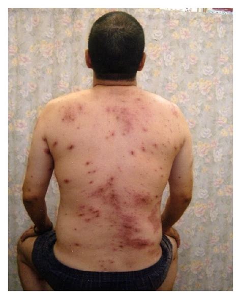 clinical features  skin rash     case    year