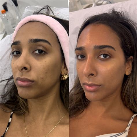 Antes E Depois Do Peeling Quimico - Clinica - Antes e depois, com apenas 15 dias de botox e peeling químico ...