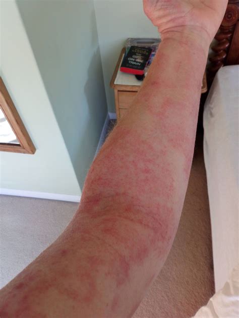 Discovering MEnopause - Itchy skin - The Coddiwomple Lady