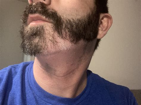 Alopecia Barbae since May : r/Minoxbeards