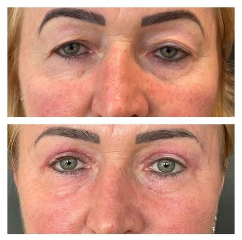 Laser Co2 Pálpebras Antes E Depois