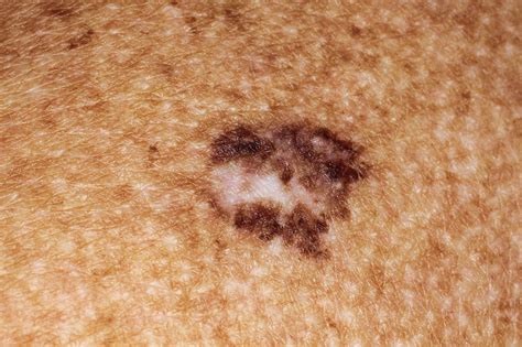 Do I Need to See a Dermatologist for Skin Cancer Screening?