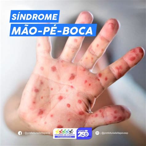 Cid 10 Mao Pe Boca