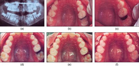 Ectopic eruption of maxillary first permanent molar | Pocket Dentistry