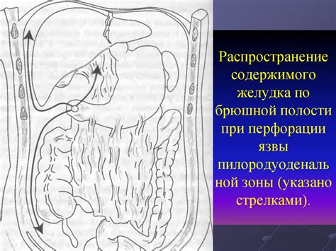 Прободные гастродуоденальные язвы - online presentation