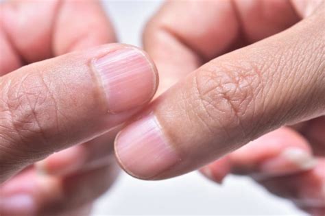 Ongles Striés : Comment Les Traiter ? » Artisans Locaux