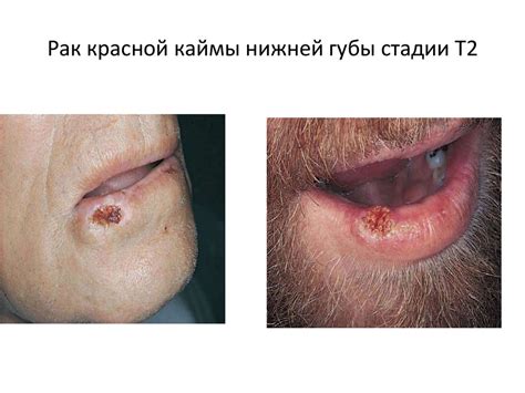 Рак слизистой оболочки полости рта и красной каймы нижней губы ...