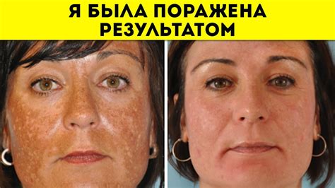 Как быстро избавиться от пигментных пятен | Расскажу свои секреты - YouTube
