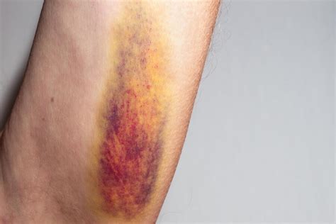 premium photo  large colored bruise   skin