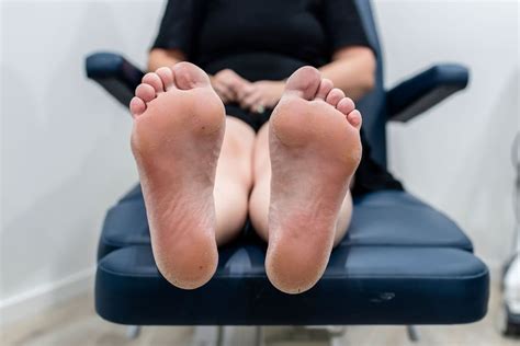 Diabetic Foot Checks