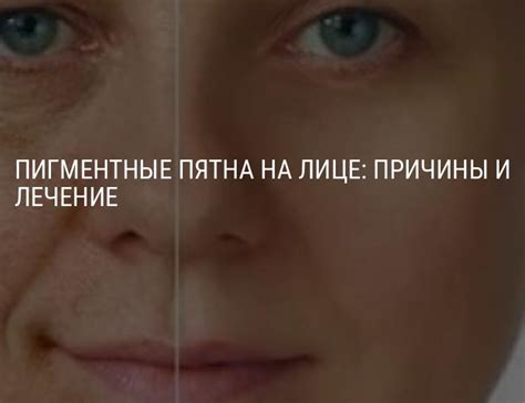 Пигментные пятна на лице: причины и лечение, как избавиться от ...