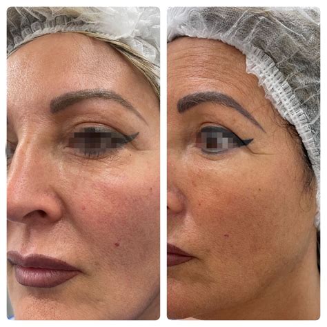 Nanofat Antes E Depois - Lipofilling facial y Nanofat en Madrid y Barcelona - Terapia regenerativa