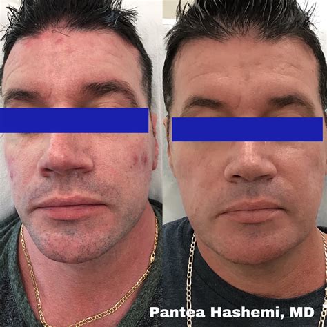face skin growth 4