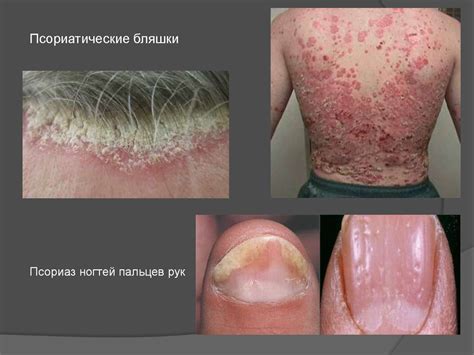 Псориаз. Этиология и патогенез псориаза - презентация онлайн