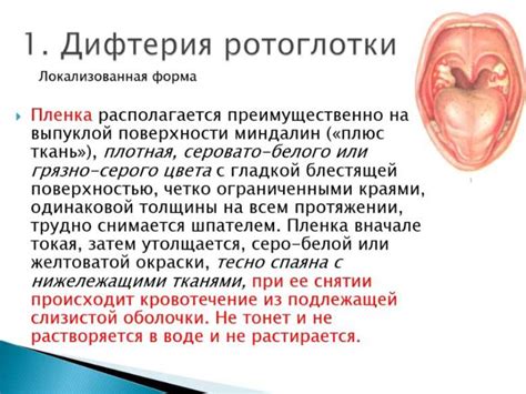 Дифтерия - презентация онлайн