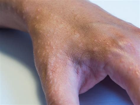 Dyshidrotic Eczema Arm