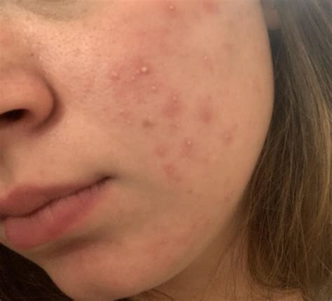 How often do you use tretinoin? : r/tretinoin