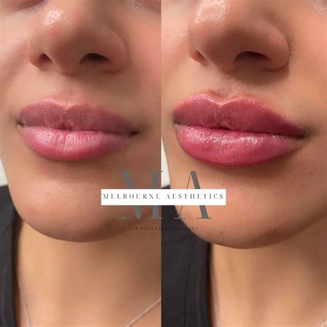 Lip Filler Melbourne - Melbourne Aesthetics