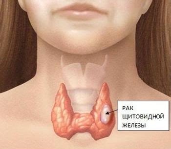 Анализ на ТТГ: расшифровка результатов, нормы — «Online Диагноз»