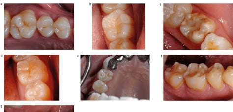 a) Occlusal surface of a premolar and molar showing no signs of erosive ...