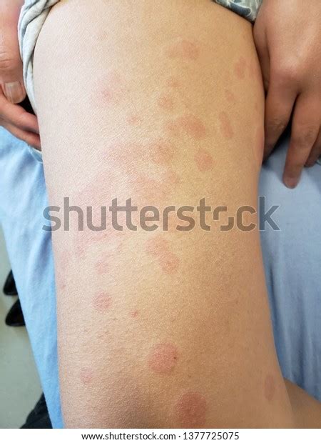 Urticaria Hives Food Allergy Red Rashes Stock Photo (Edit Now) 1377725075