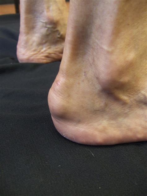 how to get rid of pain in my heel 4