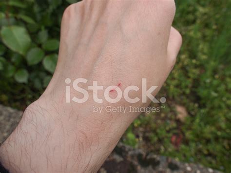 Hand Scar Stock Photo – Royalty-Free Images | FreeImages