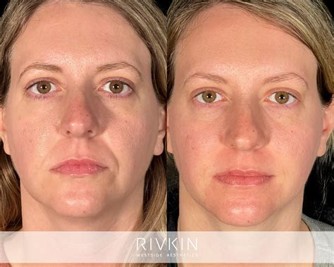 Nasolabial Fold Best Treatments For Nasolabial Folds And Marionette
