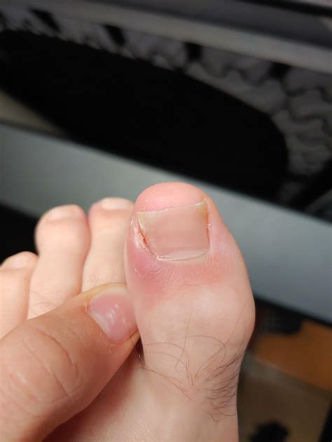 Is this toenail ingrown? The redness seems to be coming from the nail