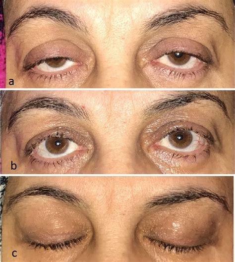 patient  underwent bilateral levator advancement surgery