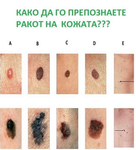 ПРЕПОЗНАЈТЕ ГО РАКОТ НА КОЖАТА!!! – Метаболизам
