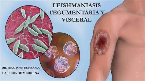 LEISHMANIASIS TEGUMENTARIA Y VISCERAL | Mr. Dr | uDocz