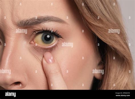 Woman with yellow eyes, closeup. Liver problems symptom Stock Photo - Alamy