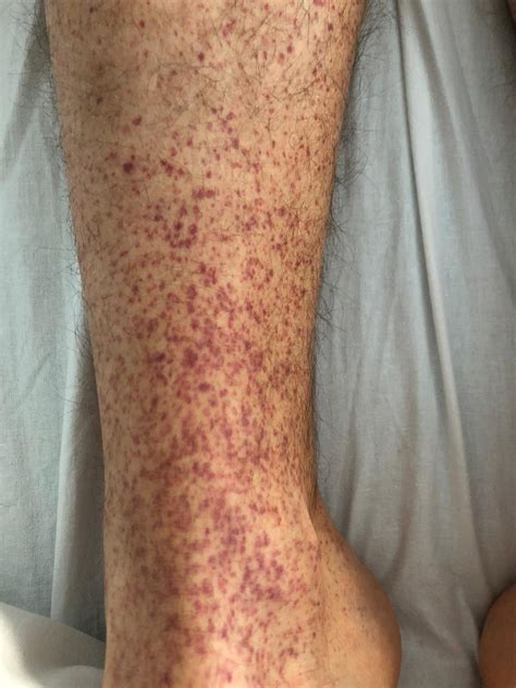 Immune thrombocytopenic purpura after SARS‐CoV‐2 vaccine - Candelli