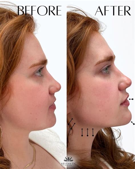 Before & After Jawline Filler | Aesthetic Beauty Lounge