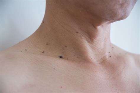Доброкачествени образувания на кожата - DERMA MED