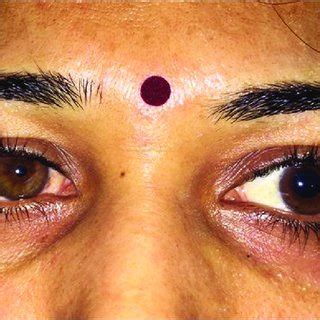 Sluggish Pupils