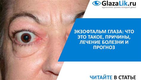 Экзофтальм глаза: что это такое, причины, лечение болезни и прогноз