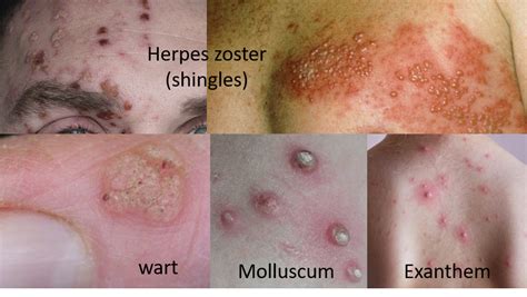 Viral skin infections
