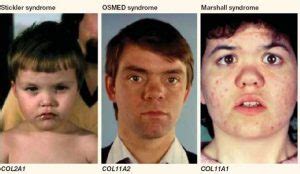 Stickler Syndrome - Pictures, What is?, Life Expectancy, Symptoms, Treat