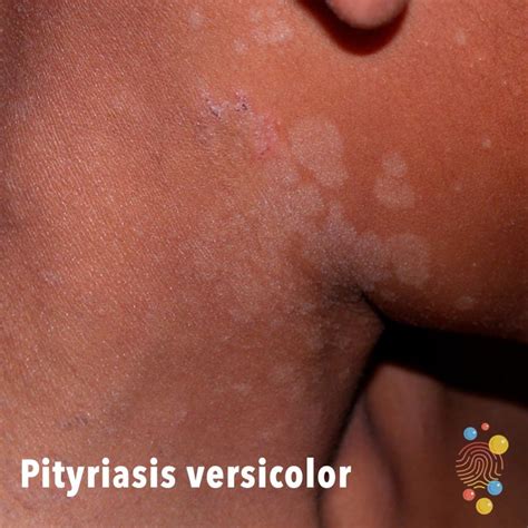 Pityriasis versicolor - Skin Deep